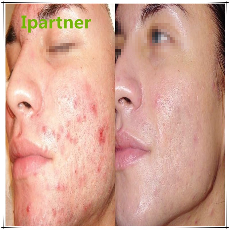 Горячая распродажа Derma Roller для ухода за кожей