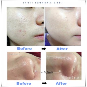 Ipartner Hydrogen кислородный пузырьковый многофункциональный очиститель для кожи 6 в 1