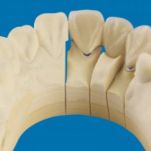 Металл-фарфоровые зубы